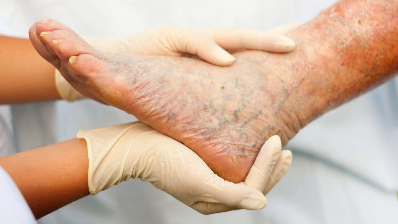 ფლებოლოგი ეხება ფეხებში ვარიკოზული ვენების მკურნალობას