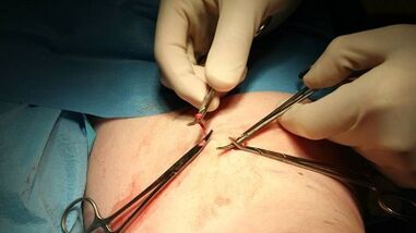 Flebectomy ვარიკოზული ვენებისთვის