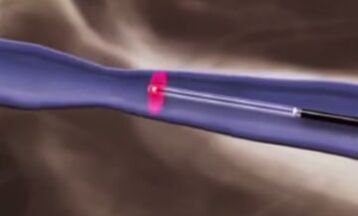 თერმული მკურნალობა